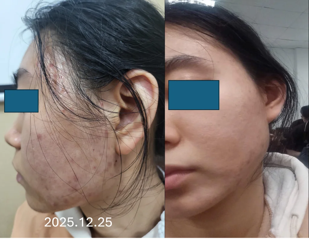 Regenew+1 + PDRN Youth Elixir Clinical + Home Case — Before / After