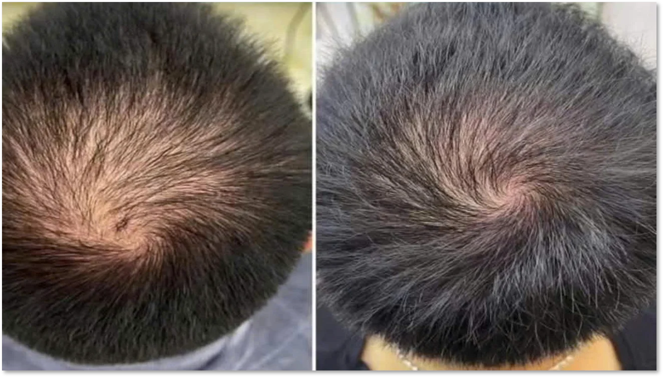 Before after male scalp